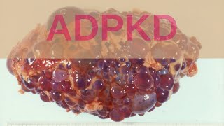 Autosomal Dominant Polycystic Kidney Disease (ADPKD) - Pathology mini tutorial