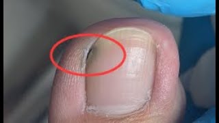 Nails are not cleaned properly and dirt is hidden