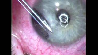 Femtosecond laser Corneal Tattoo -GRocha MD, FRCSC