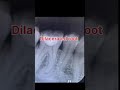 #Dental#abnormality #dilacerated#root #viralshort