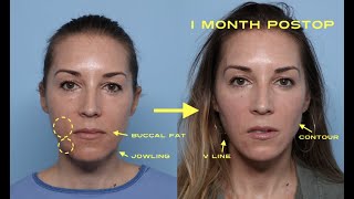 Do you need BUCCAL FAT PAD removal or JOWL reduction? Not sure? Dr. Zelken explains the difference