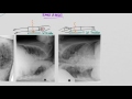 CXR Pleural effusions