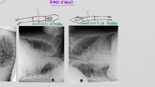 CXR Pleural effusions