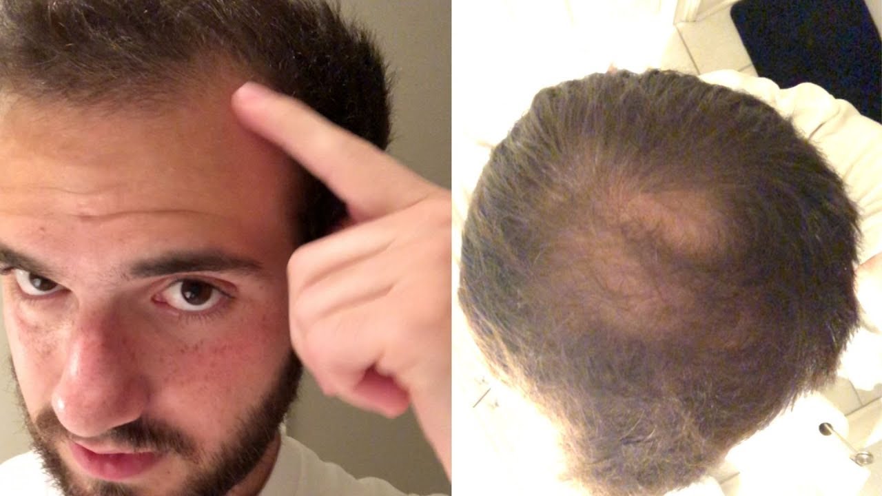 Balding Since 17 My Experience With Going Bald 17 19 Years Old
