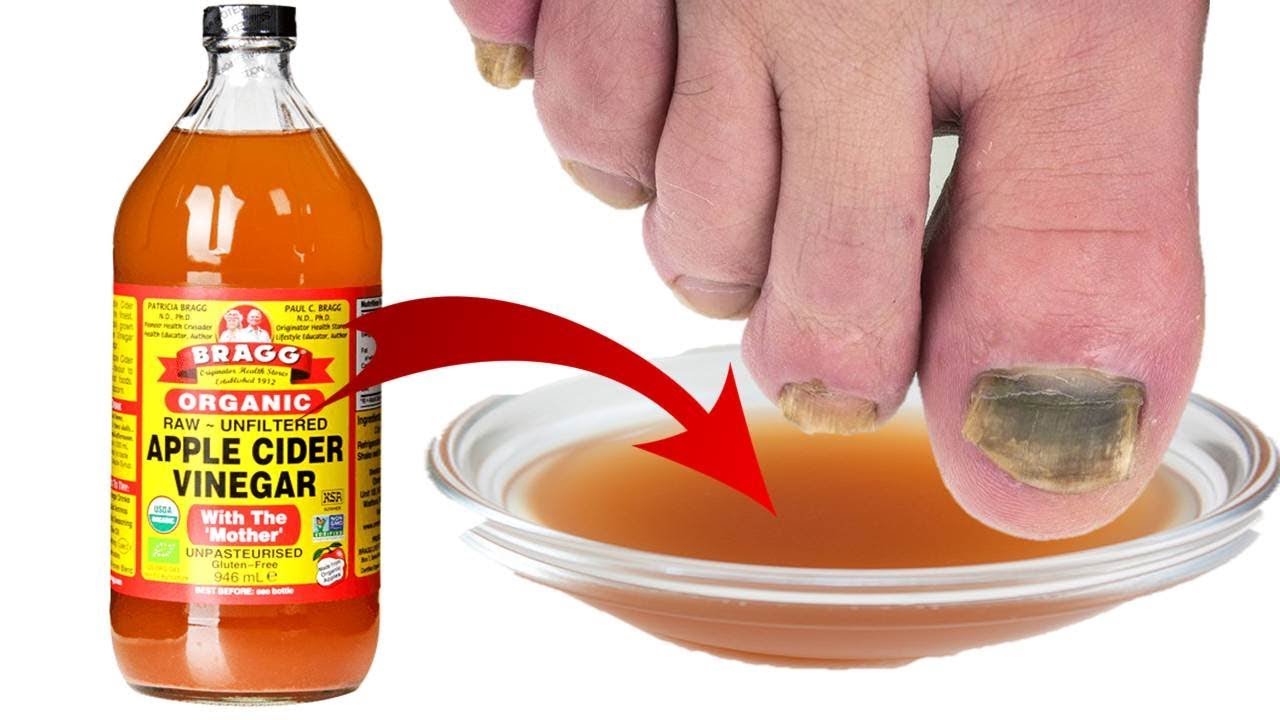 How To Use Apple Cider Vinegar For Toenail Fungus? - Ostomy Lifestyle