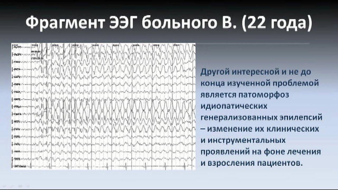 Низкоамплитудная ээг