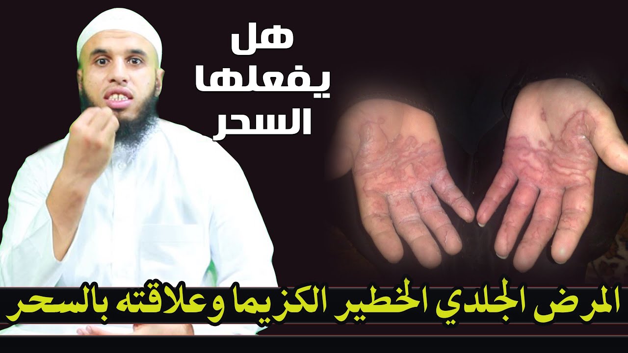 المرض الجلدي الخطير الكزيما وعلاقته بالسحر هل يفعلها السحر Youtube