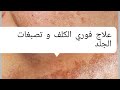 وصفة خطيرة جيدا#و رائعة لتبيض الوجه#علاج فوري للكلف و نمش#بقع داكنة و تصبغات #وصفة مذهلة