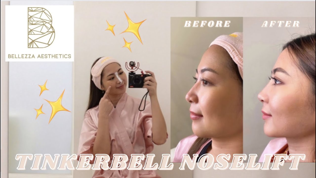 Getting a Tinkerbell Noselfit Bellezza Aesthetics Nonsurgical Noselift Nose Fillers YouTube