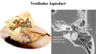 Basics of CT Petrous Bone