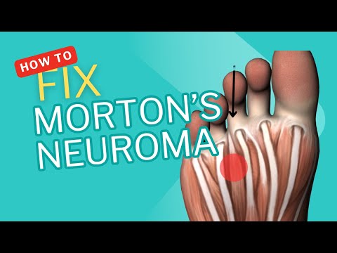 Morton S Neuroma And Running What Runners Over 35 Need To Know To Fix The Pain Fast 