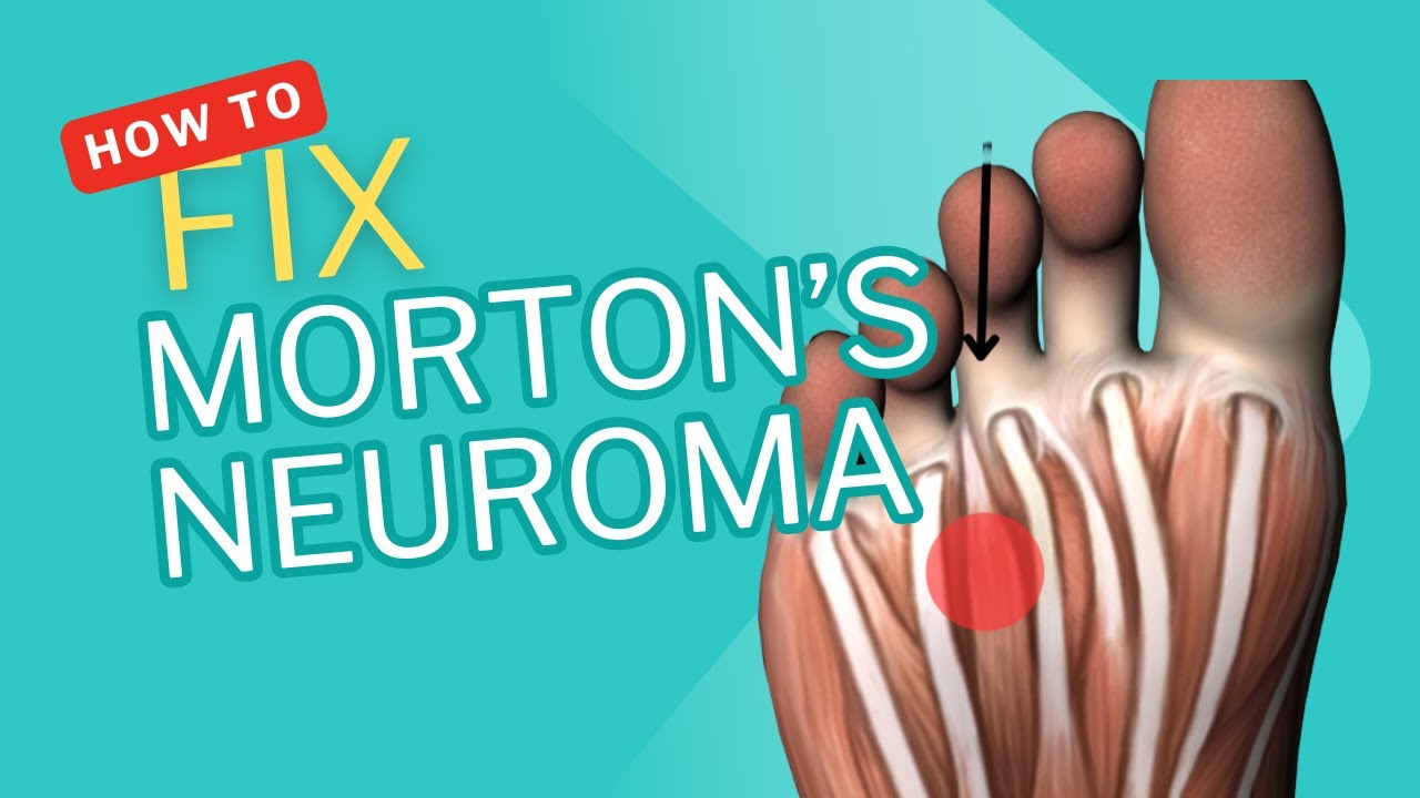 Morton’s Neuroma and Running – What Runners Over 35 Need to Know to Fix the pain Fast