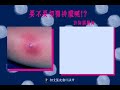 要不要切開排膿呢 何文藻皮膚科診所衛教 要不要切開排膿呢 何文藻皮膚科診所衛教