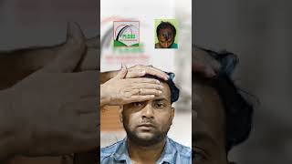 Client Feedback | Hair Transplant