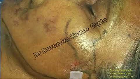 Mandibular Nerve Block V3 Neuralgia