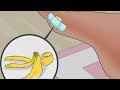 How to Painlessly Remove a SPLINTER With Banana Peel