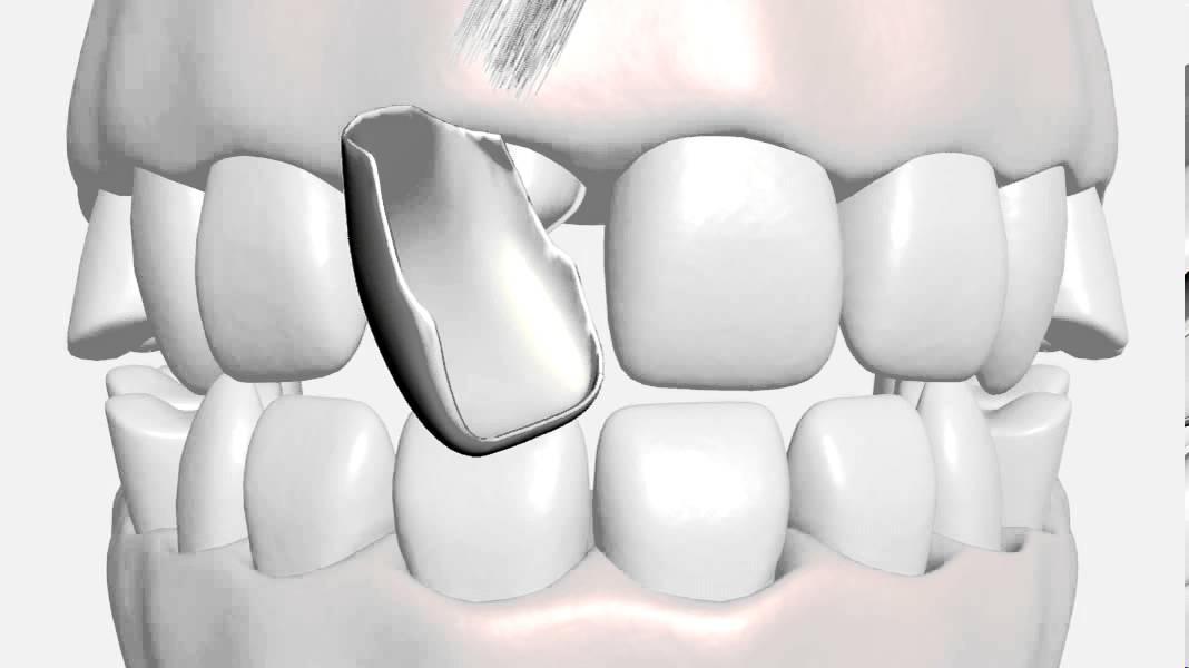 What are Porcelain Veneers & How much are Veneers Cost?