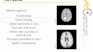 Brain Tumor Image analysis at the EU project: ContraCancrum screenshot 4