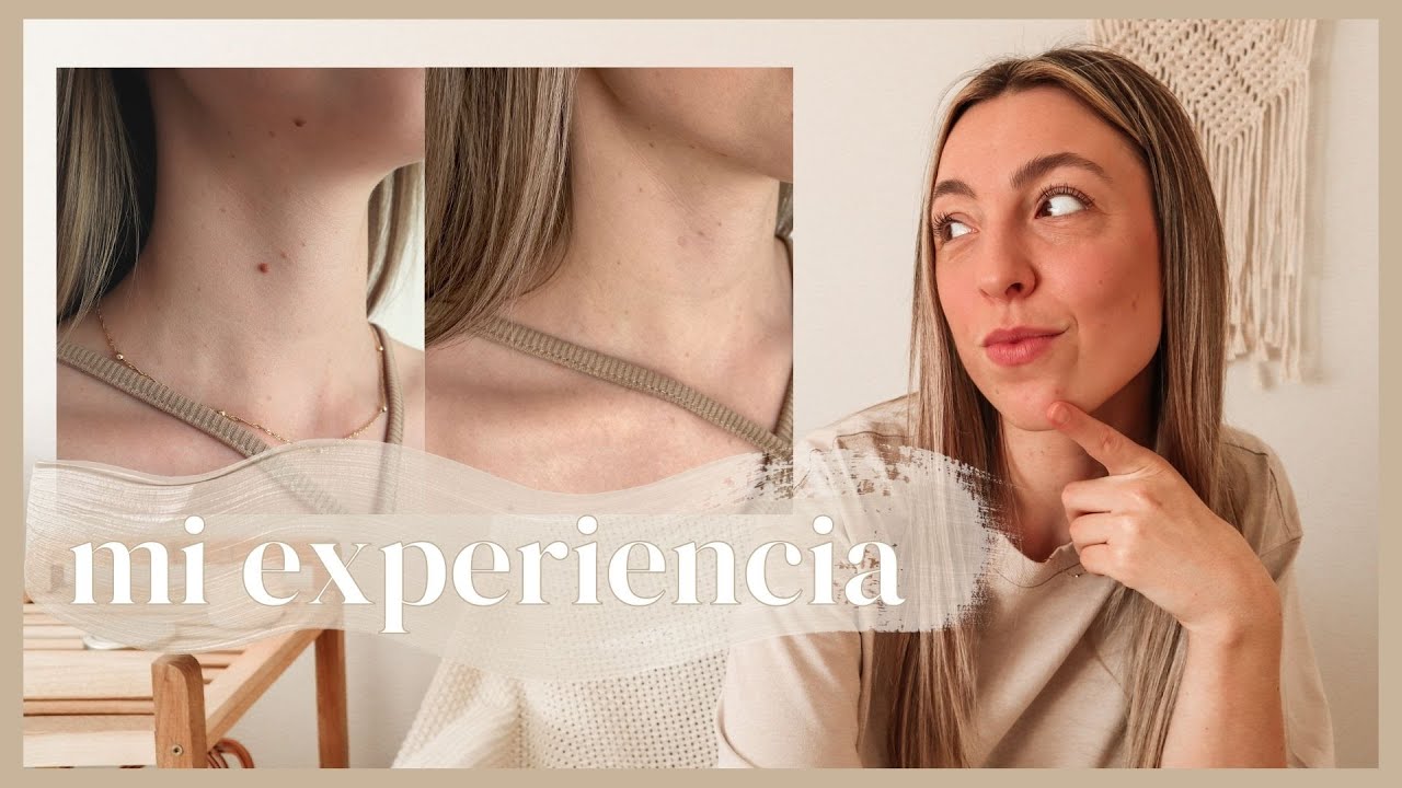 ELIMINACIÓN DE LUNARES CON LÁSER CO2 | ¡me sacan 18 lunares! | MI EXPERIENCIA