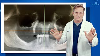 All-On-4 Dental Implants. Recipe For A Disaster