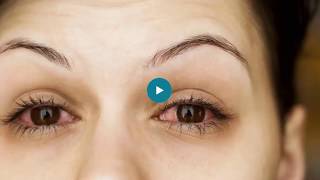 8 Reasons Your Eyes Are Red—and How to Treat Them