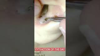 Extraction of the day