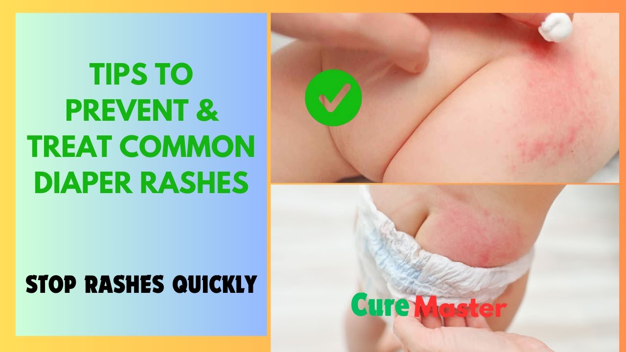 Orobase Nappy Rash TIPS TO PREVENT & TREAT COMMON DIAPER RASHES - YouTube