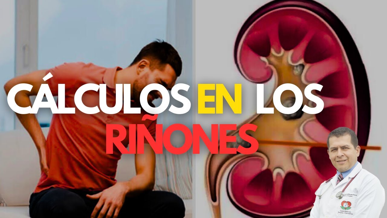 Como sanar los calculos de los riñones Dr Javier E Moreno - YouTube