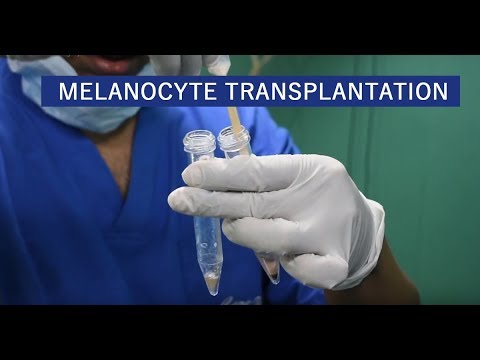 Melanocyte Transplantation For Vitiligo in Delhi, India 2021 | Care
