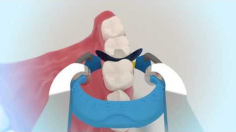 Polydentia MyRing Classico 3D video