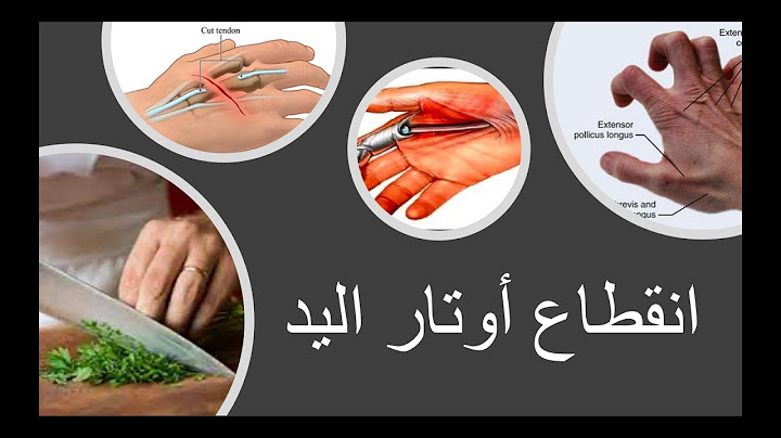 Tendon cut repair / انقطاع أوتار اليد  العضلية وعلاجها