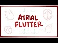 Atrial flutter  causes symptoms diagnosis treatment pathology