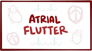 Atrial flutter - causes, symptoms, diagnosis, treatment, pathology