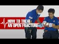 How to Treat an Open Fracture? #Lifesaver #FirstAid101