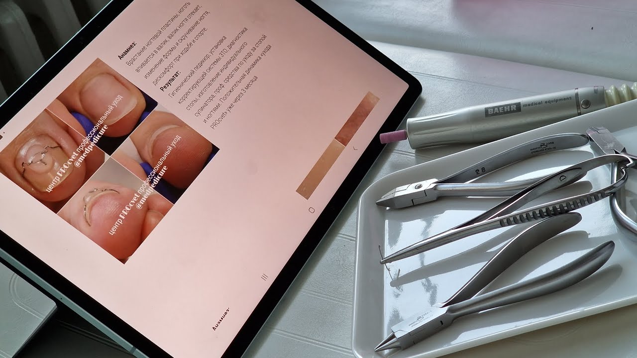 Корректирующая система 3ТО для вросшего ногтя. Крючок и его размер ...