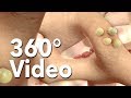 360° VR Bone Resorption | Nucleus Medical Media