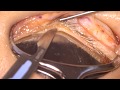 ※手術動画です 睫毛内反症に対する瞼縁切開法 Lid margin splitting法