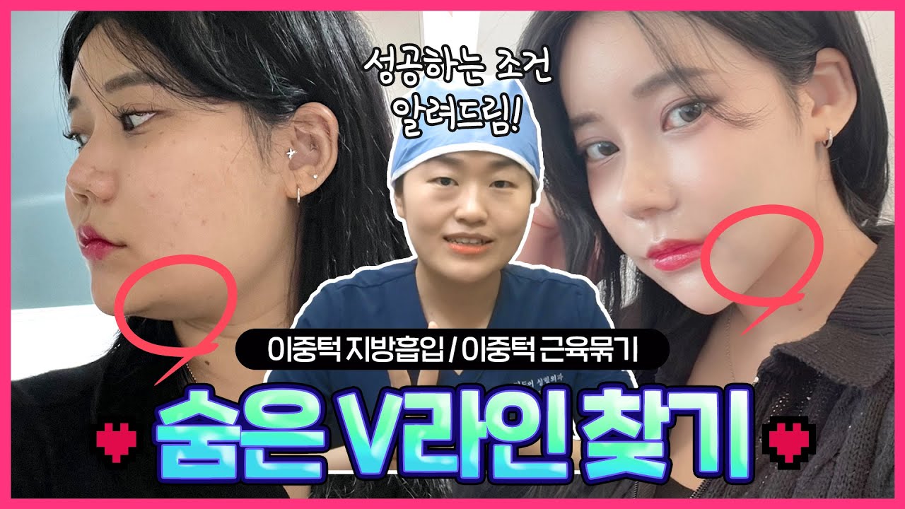 턱살 삭제, 가장 확실한 방법 #이중턱근육묶기 #이중턱지방흡입 - YouTube