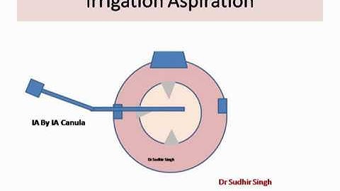 Animation ! Safe Irrigation Aspiration