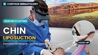 Chin Liposuction Explained |Your Questions Answered with Dr. Jochen | Contour Dermatology