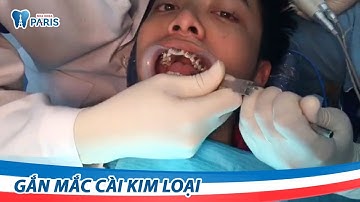 Cận cảnh gắn mắc cài kim loại tự buộc tại Nha khoa Paris