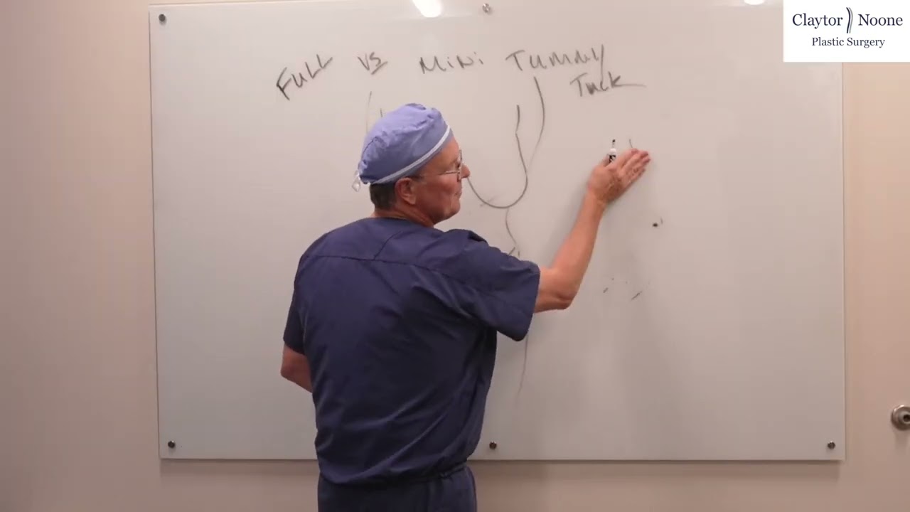 What's the difference between a full tummy tuck versus mini tummy tuck?