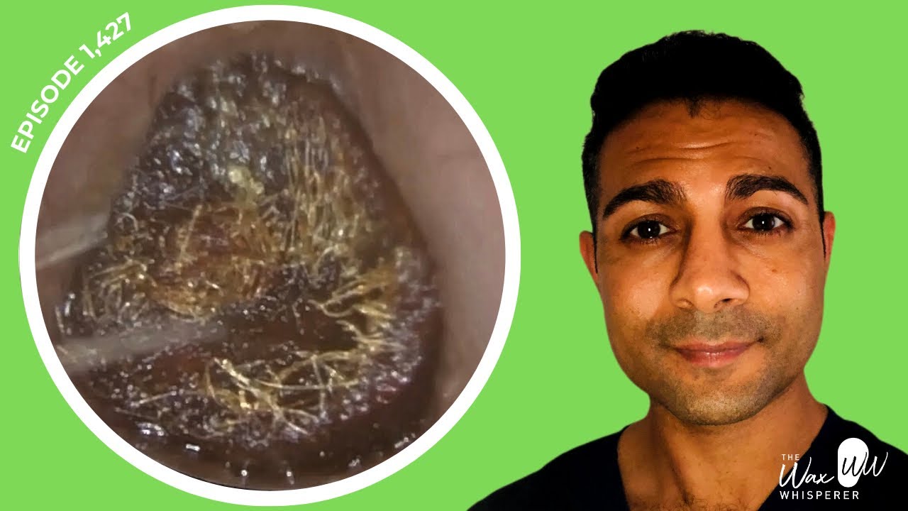 1,427 Patient’s Mother Smiling Ear to Ear After Ear Wax Removal New