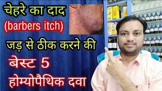 best 5 homeopathic medicine for barbers itch, how to cure barbers itch easily in hindi, fungal beard