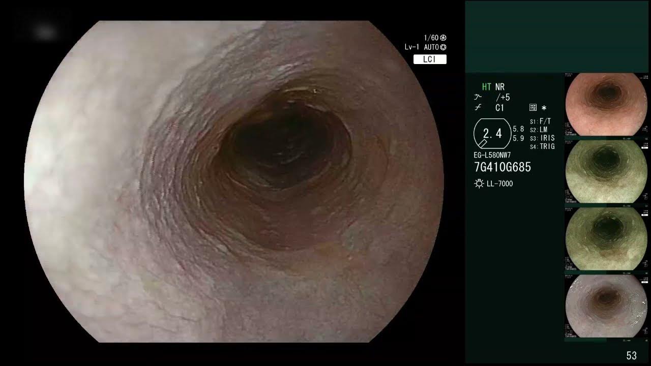 Most Common Site Of Squamous Cell Carcinoma Of Esophagus