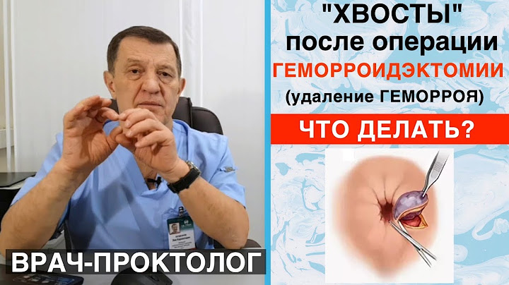 Хвосты ПОСЛЕ ОПЕРАЦИИ геморроидэктомии (удаление ГЕМОРРОЯ). Лечение геморроя