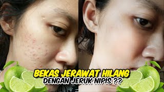 CARA MENGHILANGKAN BEKAS JERAWAT DENGAN JERUK NIPIS CEPAT DAN MUDAH DILAKUKAN