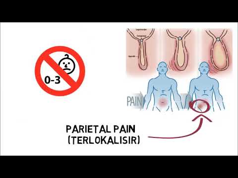 Cara Diagnosa Appendisitis Akut ? Pemeriksaan Tanda Rovsing, Psoas, Obturator, McBurney