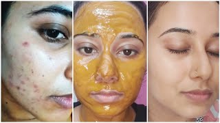 7 Days Challenge- Remove DARK SPOTS, BROWN SPOTS, PIMPLE MARKS, PIGMENTATION Naturally at Home