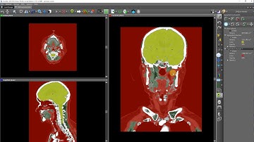 Marked watershed segmentation: CT brain tissue segmentation